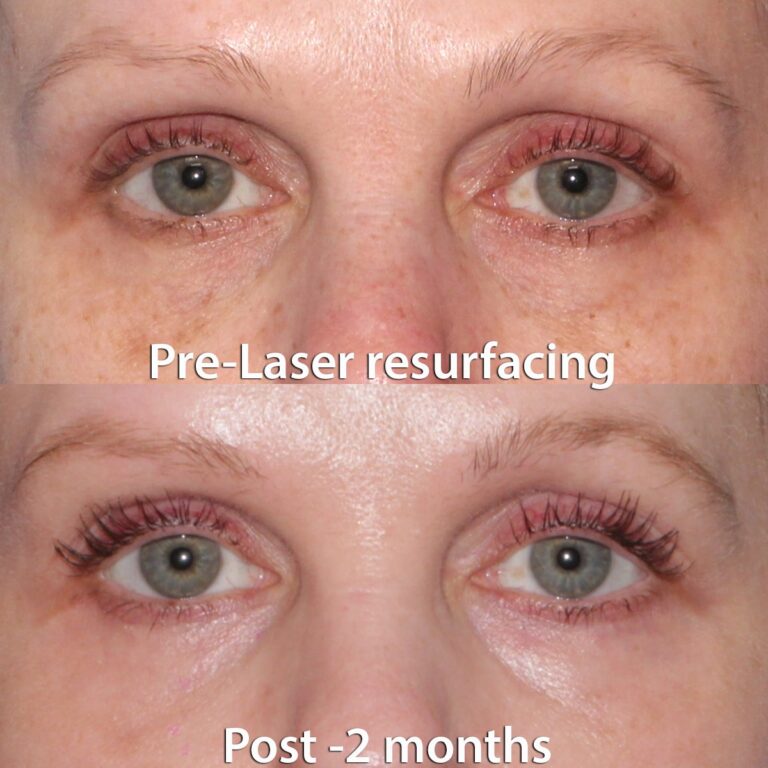 Before and after front image of a laser resurfacing treatment on a female's skin around the eyes performed by Dr. Groff at our San Diego med spa