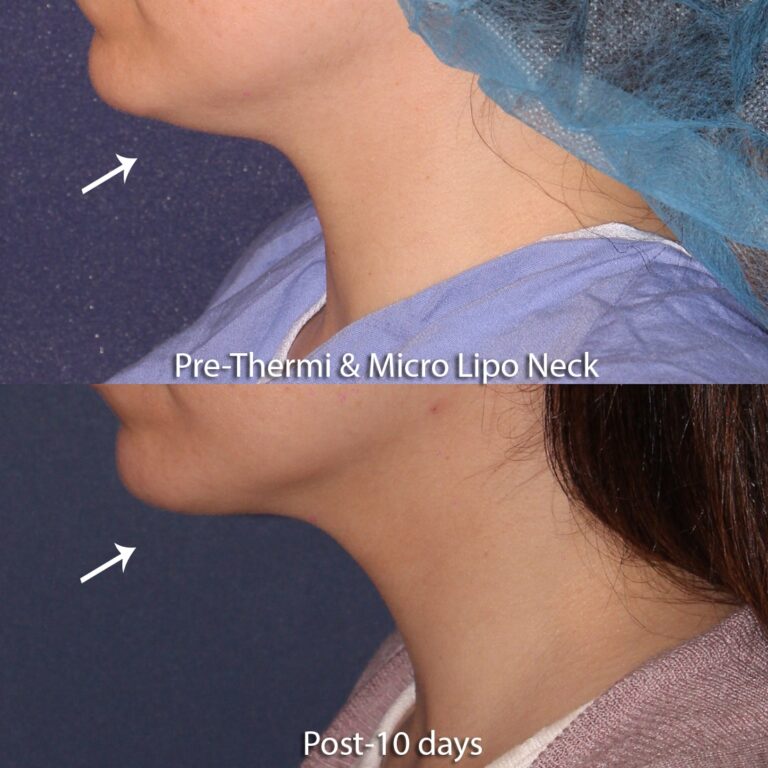 Before and after side image of liposculpture and ThermiTight treatment on a female's chin performed by Dr. Groff at our San Diego medical spa
