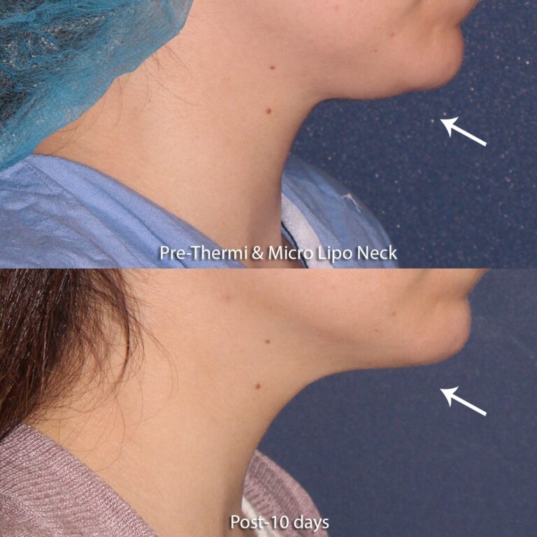 Before and after side image of liposculpture and ThermiTight treatment on a female's chin performed by Dr. Groff at our San Diego medical spa