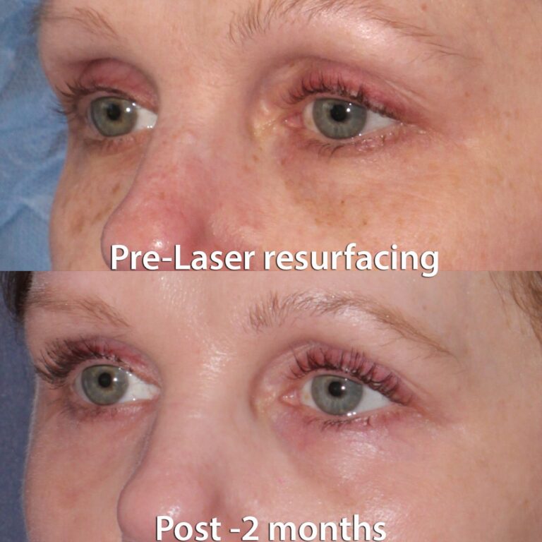 Before and after oblique image of a laser resurfacing treatment on a female's skin around the eyes performed by Dr. Groff at our San Diego med spa