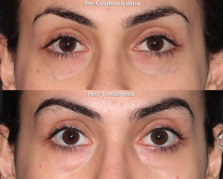 Before and after front image of a CoolTouch Varia treatment on a female's veins near the eyes performed by Dr. Groff at our San Diego medical spa