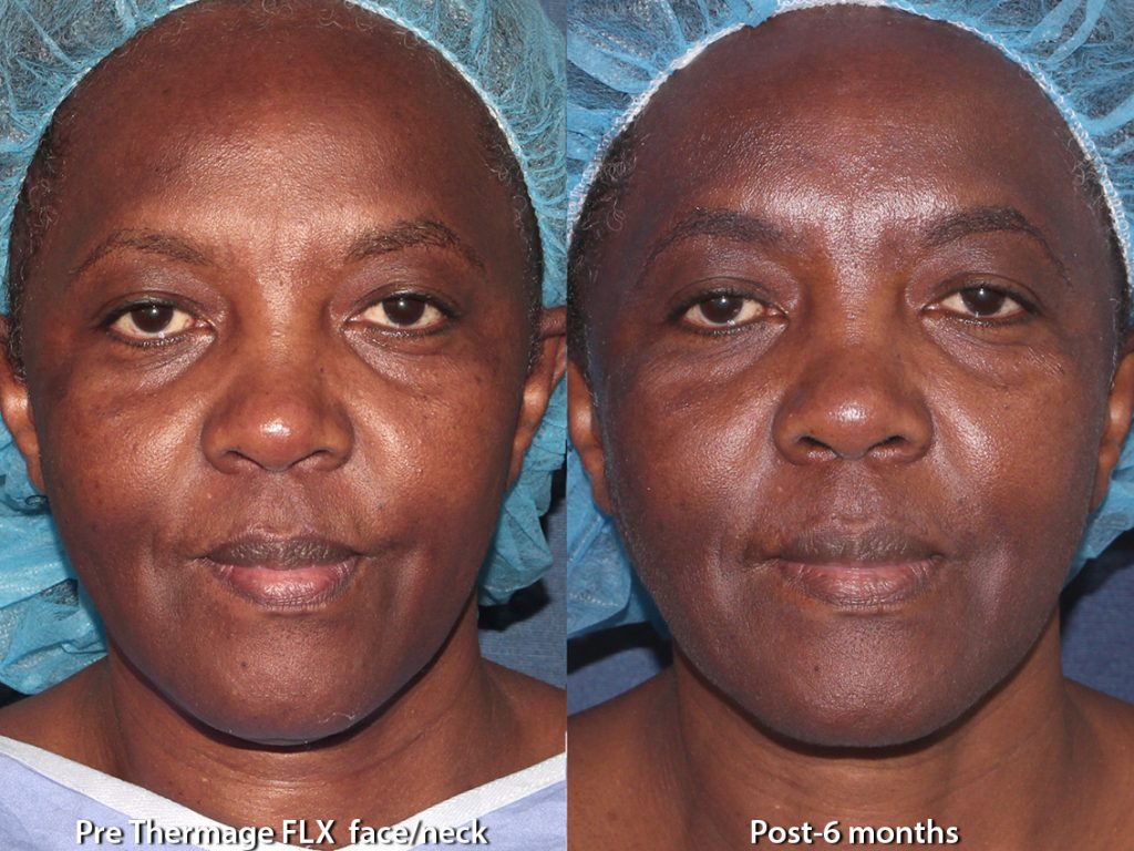 Actual un-retouched patient before and after Thermage to tighten skin by Leysin Fletcher, PA-C. Disclaimer: Results may vary from patient to patient. Results are not guaranteed.