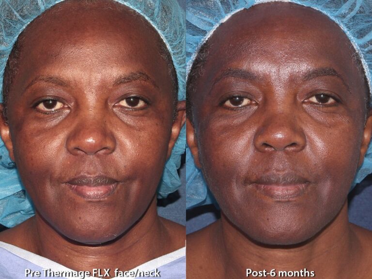 Before and after front image of Thermage treatment on a female's face performed by Leysin Fletcher, PA-C, at our San Diego med spa