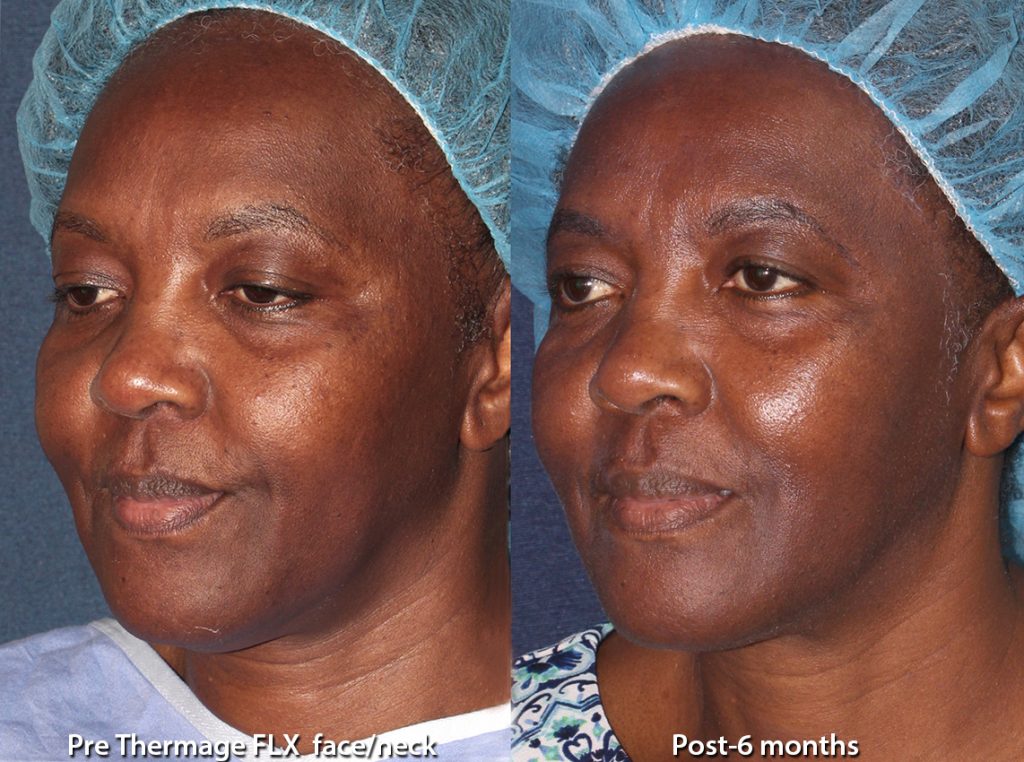 Actual un-retouched patient before and after Thermage skin tightening by Leysin Fletcher, PA-C. Disclaimer: Results may vary from patient to patient. Results are not guaranteed.