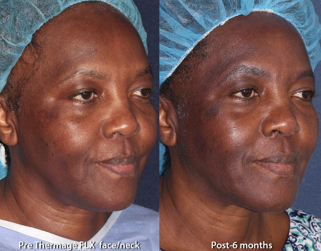 Actual un-retouched patient before and after Thermage for skin tightening  by Leysin Fletcher, PA-C. Disclaimer: Results may vary from patient to patient. Results are not guaranteed.