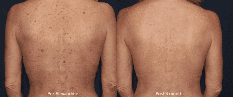 Before and after back image of Alexandrite laser treatment on a female's back performed by Dr. Groff at our San Diego medical spa