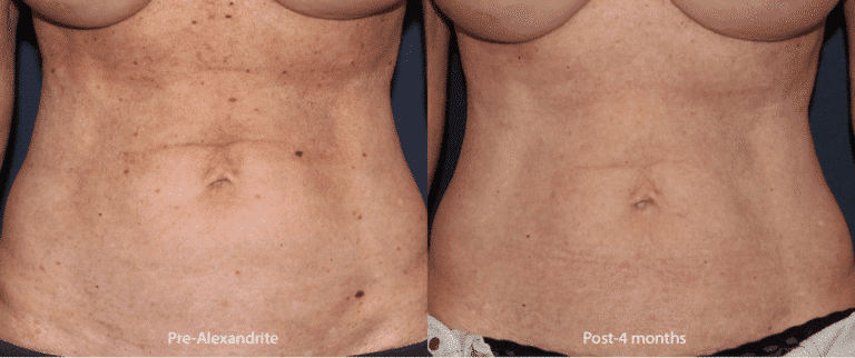 Before and after front image of Alexandrite laser treatment on a female's abdomen performed by Dr. Groff at our San Diego medical spa