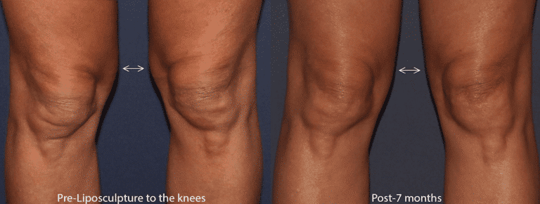 Before and after front image of liposculpture treatment on a female's knees performed by Dr. Groff at our San Diego medical clinic