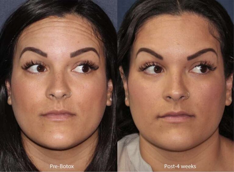 Before and after front image of Botox treatment on a female's forehead lines performed by Dr. Wu at our San Diego medical spa