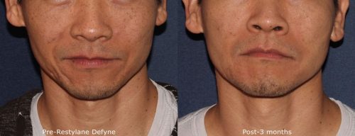 Before and after front image of Restylane Defyne treatment on a male's acne scars performed by Dr. Wu at our San Diego medical spa