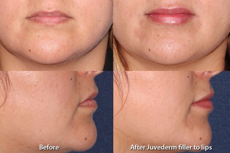 Before and after front and side image of Juvederm treatment on a female's face performed by Dr. Boen at our San Diego med spa