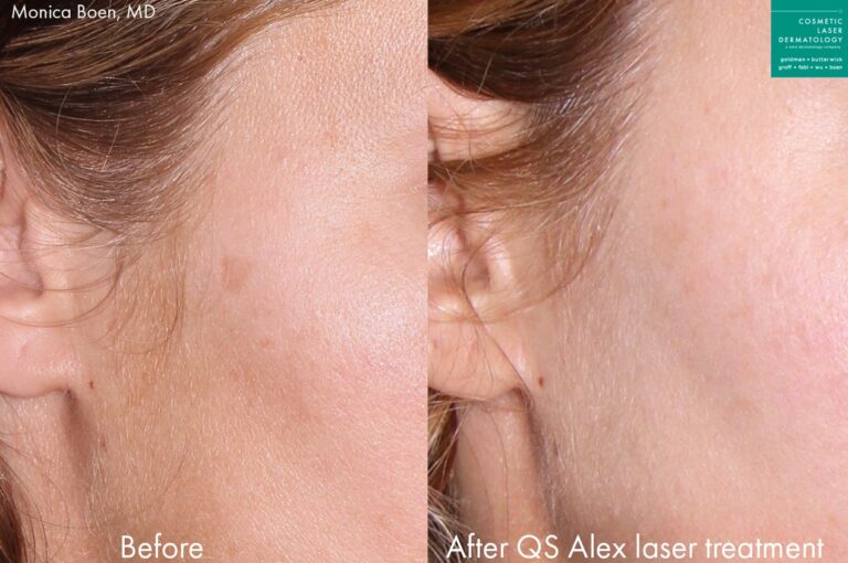Before and after oblique image of Alexandrite laser treatment on a female's cheek performed by Dr. Boen at our San Diego medical clinic