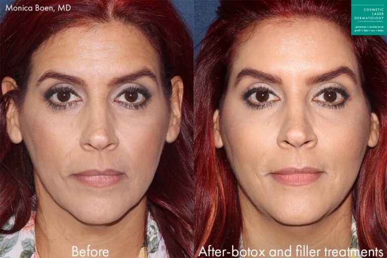 Before and after front image of Botox treatment on a female's face performed by Dr. Boen at our San Diego medical clinic