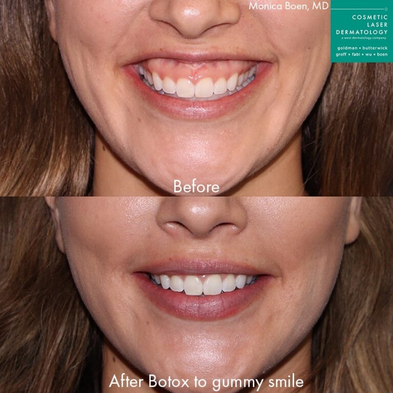 botox treatment for a gummy smile, before and after the procedure