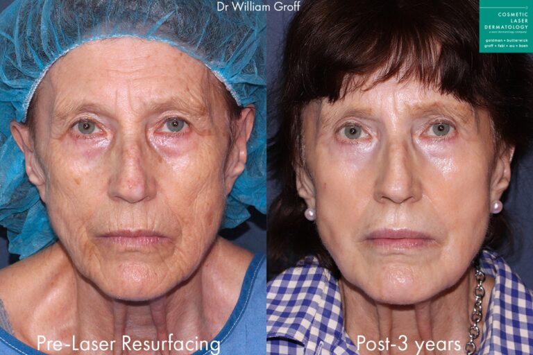 Before and after front image of laser resurfacing treatment on a female's face performed by Dr. Groff at our San Diego medical clinic
