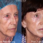 before and adfter of a laser resurfacing treatment with 3 years in between at cosmetic laser dermatology in san diego, ca