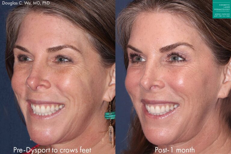 Before and after oblique image of Botox treatment on a female's crow's feet performed by Dr. Wu at our San Diego medical spa