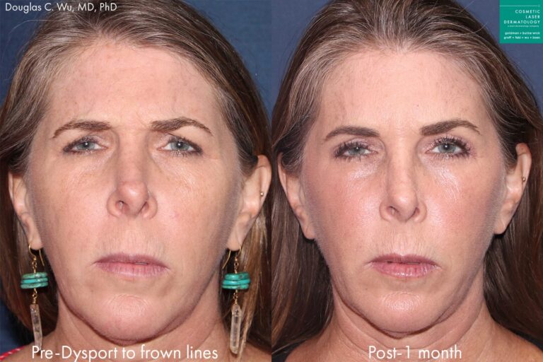 Before and after front image of Botox treatment on a female's frown lines performed by Dr. Wu at our San Diego medical spa