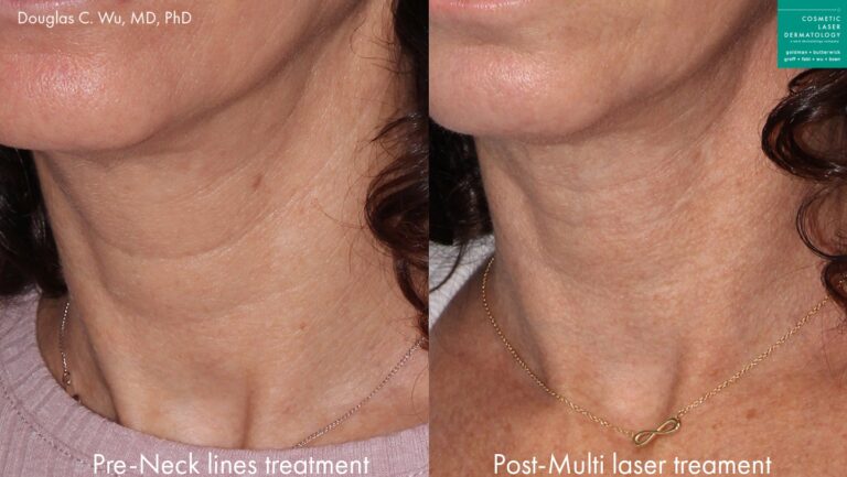 Before and after oblique image of laser resurfacing treatment on a female's neck performed by Dr. Wu at our San Diego medical spa