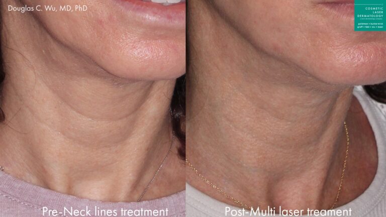 Before and after oblique image of laser resurfacing treatment on a female's neck performed by Dr. Wu at our San Diego medical spa