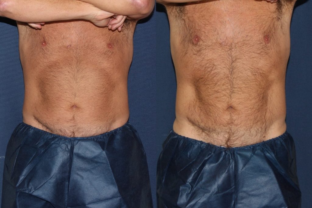 coolsculpting results on a male patient