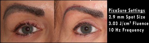 before and after of an eyebrow that under went picosure laser procedure