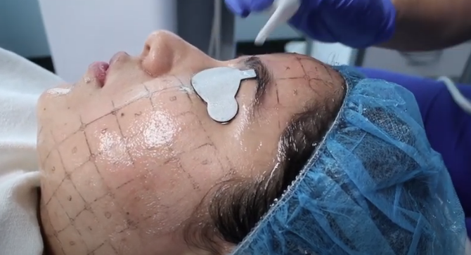 cosmetic laser dermatology Thermage skin tightening treatment in san diego, ca