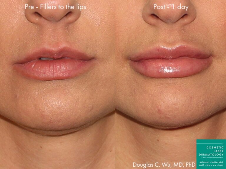 Before and after front image of lip filler treatment on a female's lips performed by Dr. Wu at our San Diego medical spa