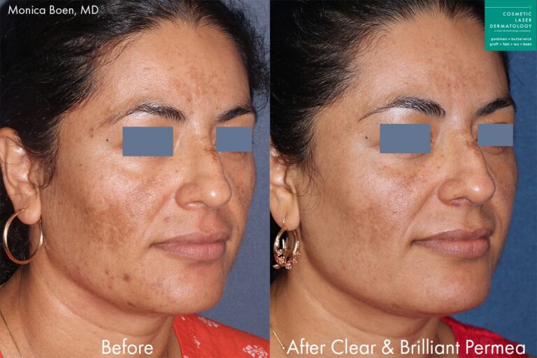 Before and after oblique image of Clear and Brilliant treatment on a female's face performed by Dr. Boen at our San Diego medical spa