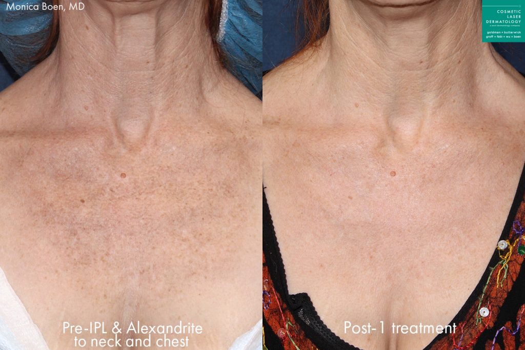 Before and after front image of IPL and Alexandrite treatment on a female's neck and chest performed by Dr. Boen at our San Diego medical spa