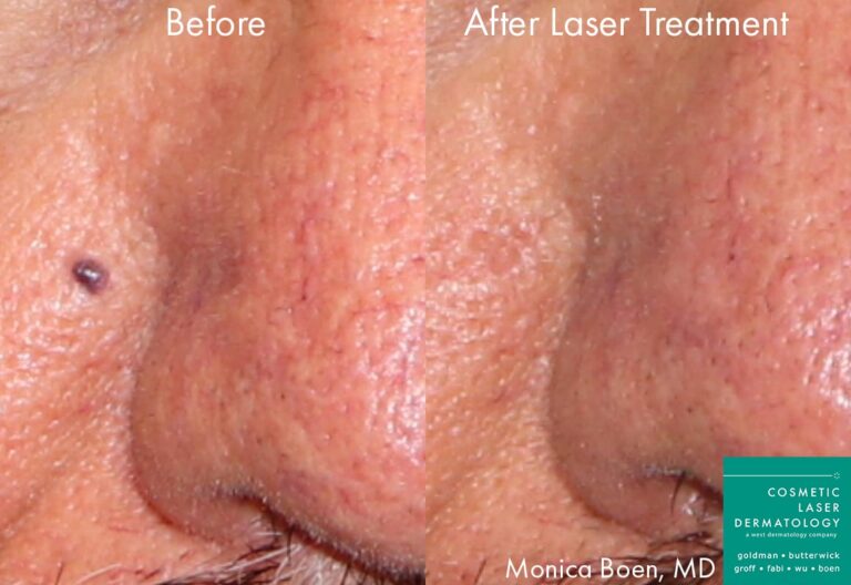 Before and after front image of Vbeam treatment on a male's cheek performed by Dr. Boen at our San Diego medical spa