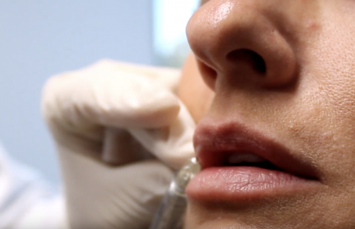 Injecting botox and dermal fillers into lips in san diego, ca