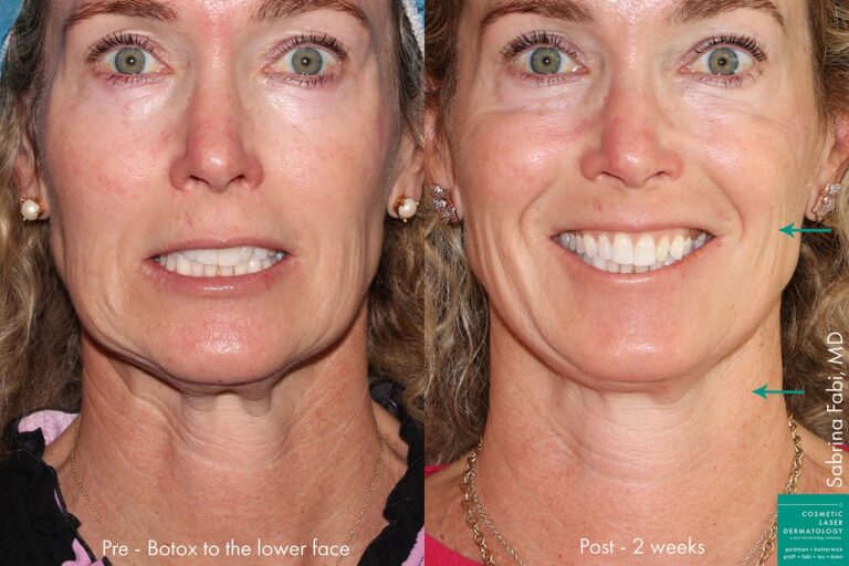 Before and after front image of Botox treatment on a female's neck and face performed by Dr. Fabi at our San Diego medical spa