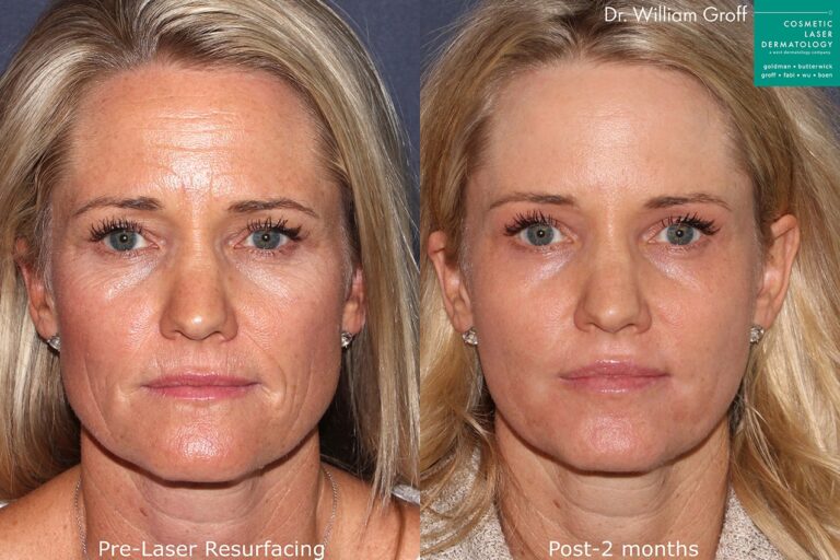 Before and after front image of laser resurfacing treatment on a female's face performed by Dr. Groff at our San Diego medical spa