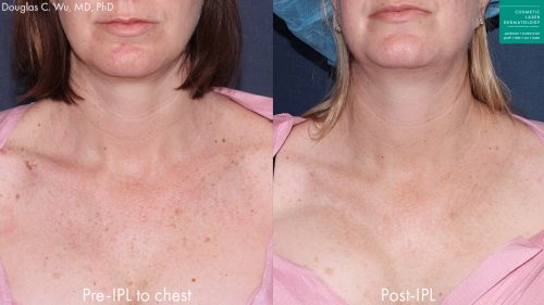 Prevention and Treatment Options for Vertical Chest Wrinkles - Summit  Plastic Surgery & Dermatology