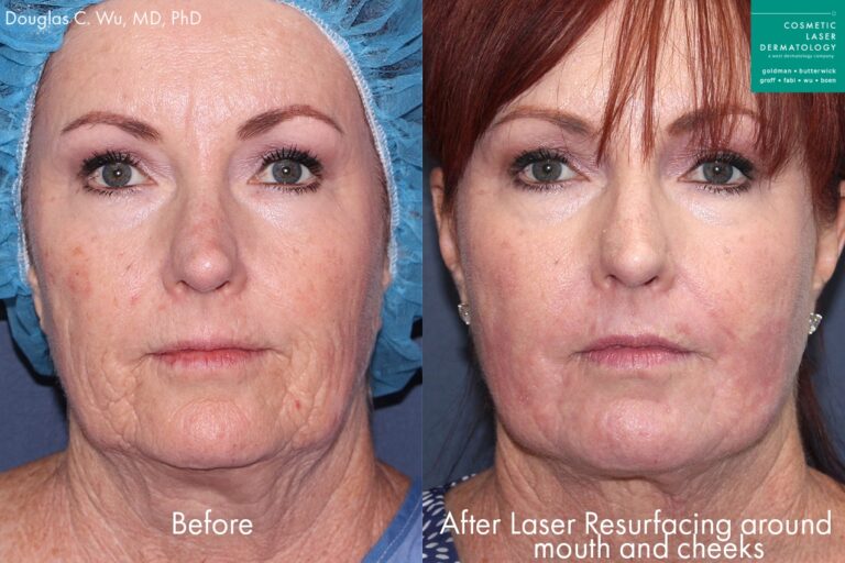 Before and after front image of laser resurfacing treatment on a female's face performed by Dr. Wu at our San Diego medical clinic