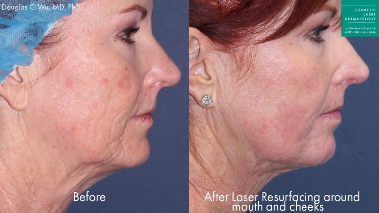 Before and after side image of laser resurfacing treatment on a female's face performed by Dr. Wu at our San Diego medical clinic