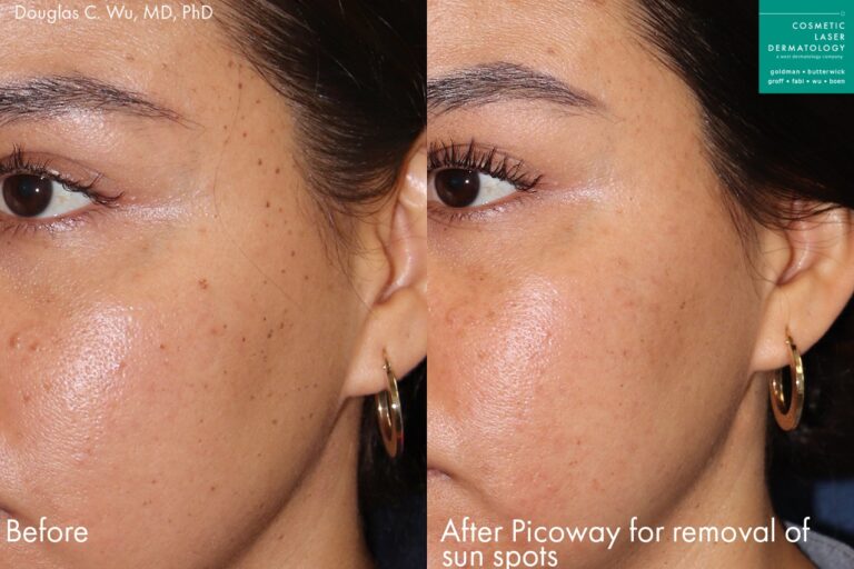Before and after oblique image of PicoWay treatment on a female's face performed by Dr. Wu at our San Diego medical spa