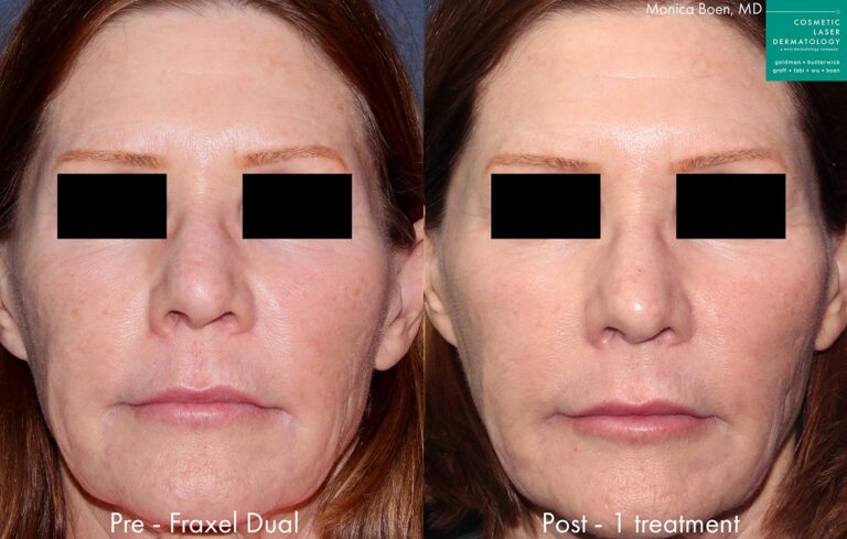 Before and after front image of Fraxel treatment on a female's face performed by Dr. Boen at our San Diego medical spa