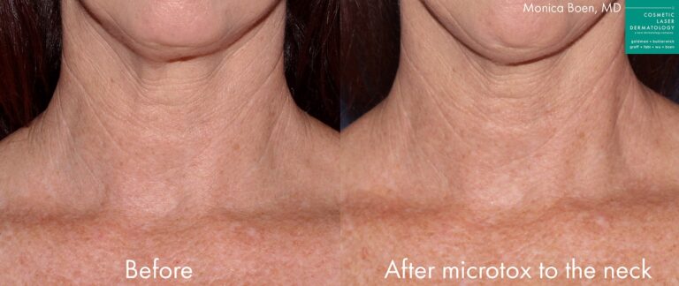 Before and after front image of Microtox treatment on a female's neck performed by Dr. Boen at our San Diego med spa