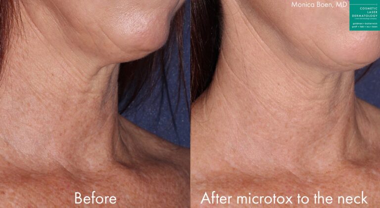 Before and after oblique image of Microtox treatment on a female's neck performed by Dr. Boen at our San Diego med spa