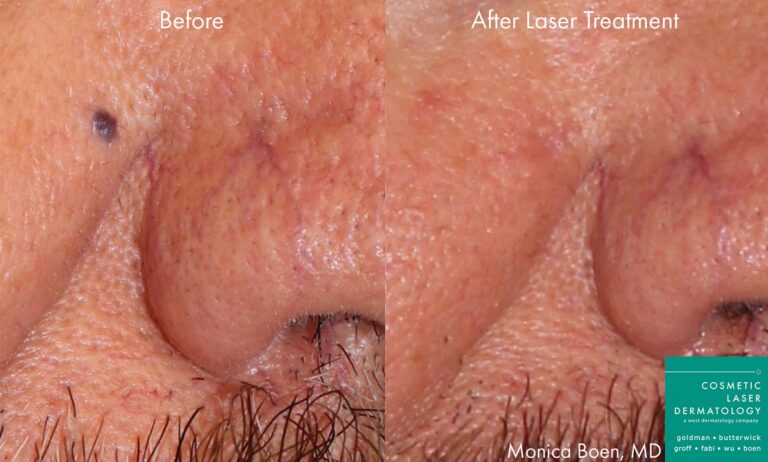 Before and after oblique image of Vbeam treatment on a male's cheek performed by Dr. Boen at our San Diego medical clinic