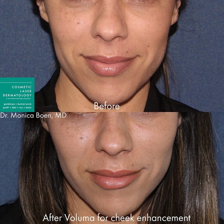 Before and after front image of Voluma treatment on a female's cheeks performed by Dr. Boen at our San Diego medical clinic