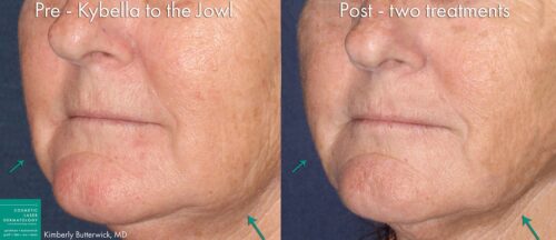 Before and after oblique image of Kyballa treatment on a male's chin performed by Dr. Butterwick at our San Diego medical clinic