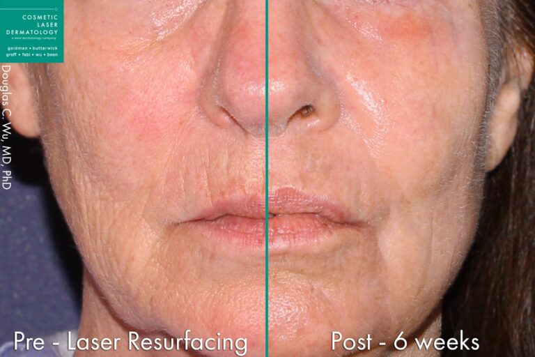 Before and after front image of laser treatment on a female's face performed by Dr. Wu at our San Diego dermatology clinic