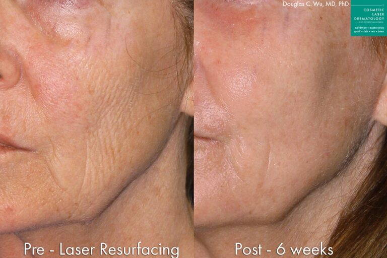 Before and after oblique image of laser treatment on a female's face performed by Dr. Wu at our San Diego dermatology clinic