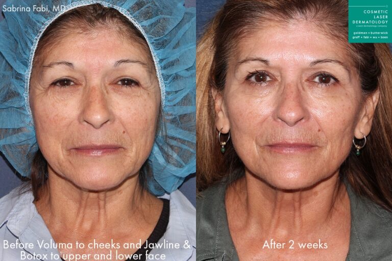 Before and after front image of Botox and Voluma treatment on a female's face performed by Dr. Fabi at our San Diego medical clinic