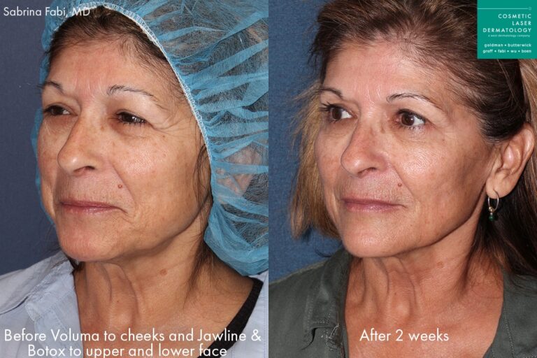 Before and after oblique image of Botox and Voluma treatment on a female's face performed by Dr. Fabi at our San Diego medical clinic