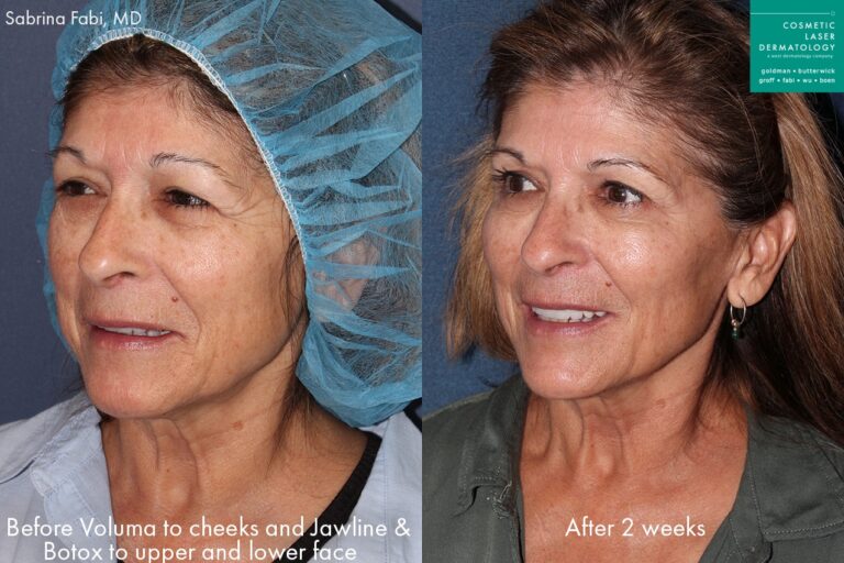 Before and after oblique image of Botox and Voluma treatment on a female's face performed by Dr. Fabi at our San Diego medical clinic