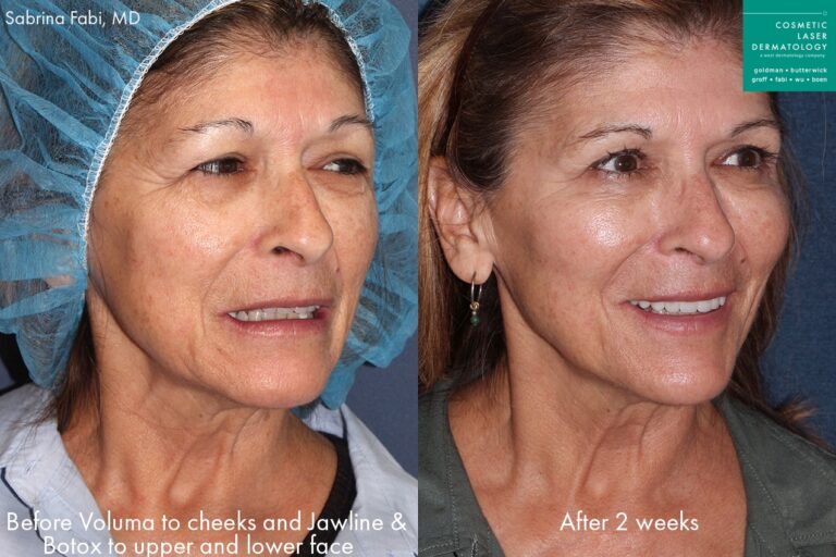 Before and after oblique image of Botox and Voluma treatment on a female's face performed by Dr. Fabi at our San Diego medical clinic